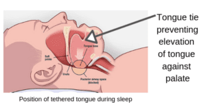 Tongue tie preventing tongue from moving up against palate