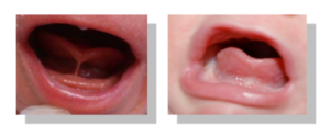 what you need to know about tongue ties in children and babies