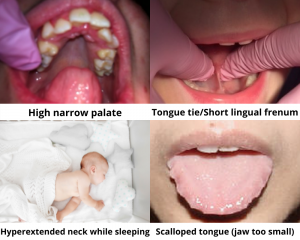 high narrow palate, tongue tie, hyperextended neck, scalloped tongue (jaw too small)