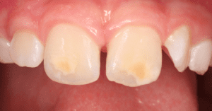 hereditary issues can cause cavities