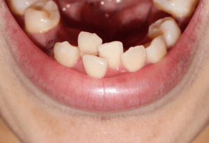 orthodontic crowding
