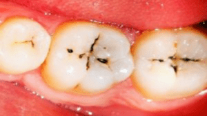 common causes of cavities grooves in teeth