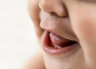 Tongue Tie in Baby and Frenectomy