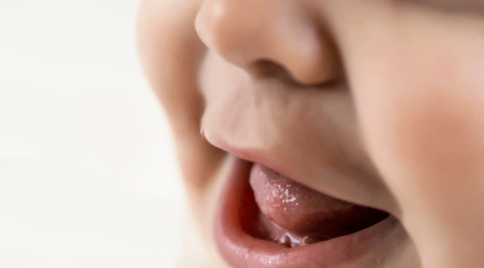 Tongue Tie in Baby and Frenectomy