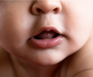 What do I do if my baby has a tongue tie?