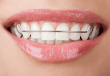 Retaining That Smile! What You Need to Know About Retainers