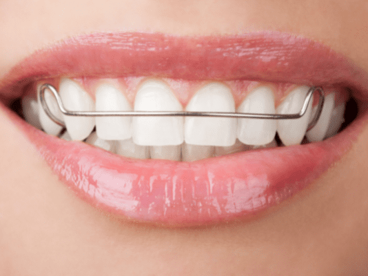 Retaining That Smile! What You Need to Know About Retainers