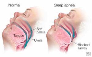 Sleep apnea and tongue ties