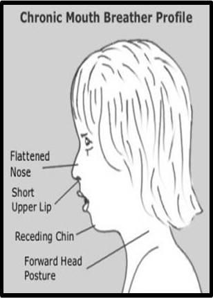 Tongue Ties Part 2: Why a “Quick Snip” is Rarely a Quick Fix