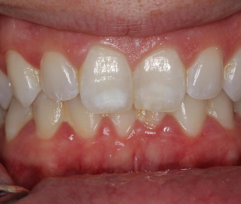 White marks on kids teeth