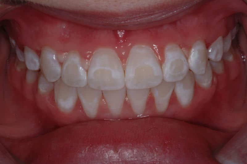 White spots on teeth after braces