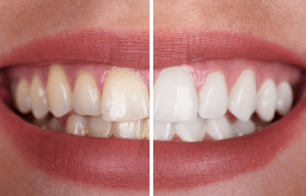 Teeth Whitening for Teens