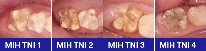 MIH: A Common Dental Condition 